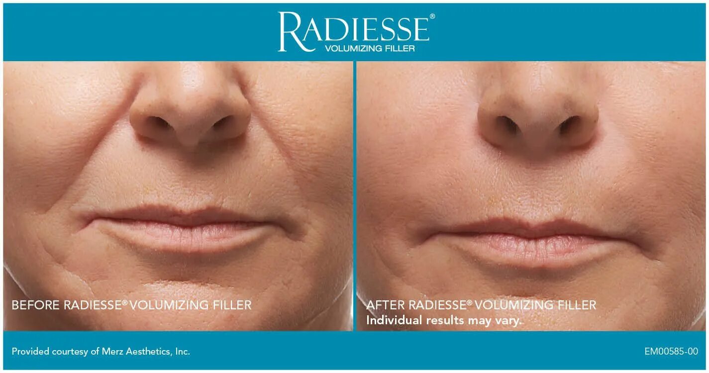 Радиесс отзывы фото до и после цена Radiesse helps fill deep wrinkles and can last almost a year. At avecinia, Radie