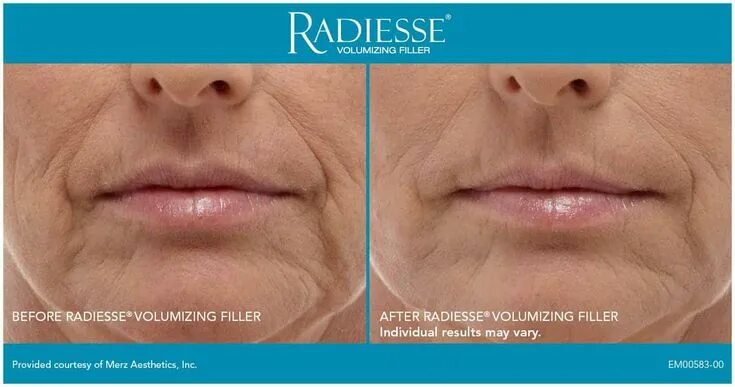 Радиесс отзывы фото до и после цена Experience Radiesse Filler in the hands of expert injector Dominique Well in Sea