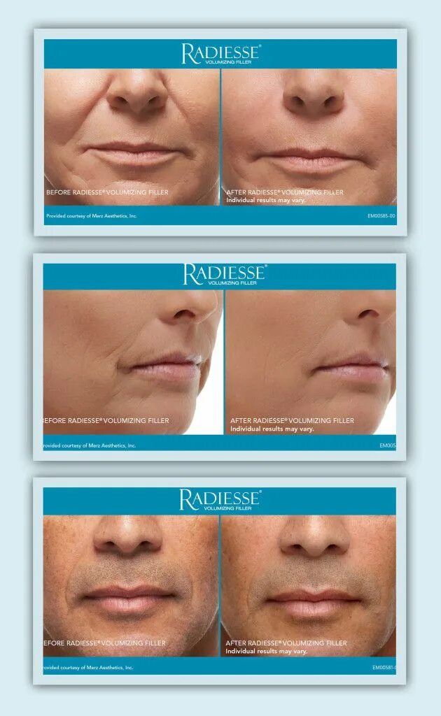 Радиесс отзывы фото до и после цена Dermal Fillers Injectables Salt Lake City, Utah Save 15% Off First Visit! Dermal