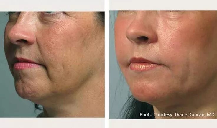 Радиолифтинг для лица фото до и после FaceTite NYC Dr. Thomas Loeb Facial surgery, Facial, Skin