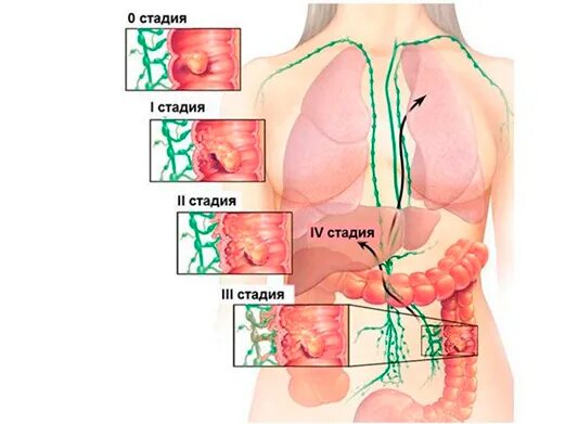 Рак 3 стадии фото Стадии рака ободочной кишки - особенности лечения и прогнозы. - Хирург К. В. Пуч