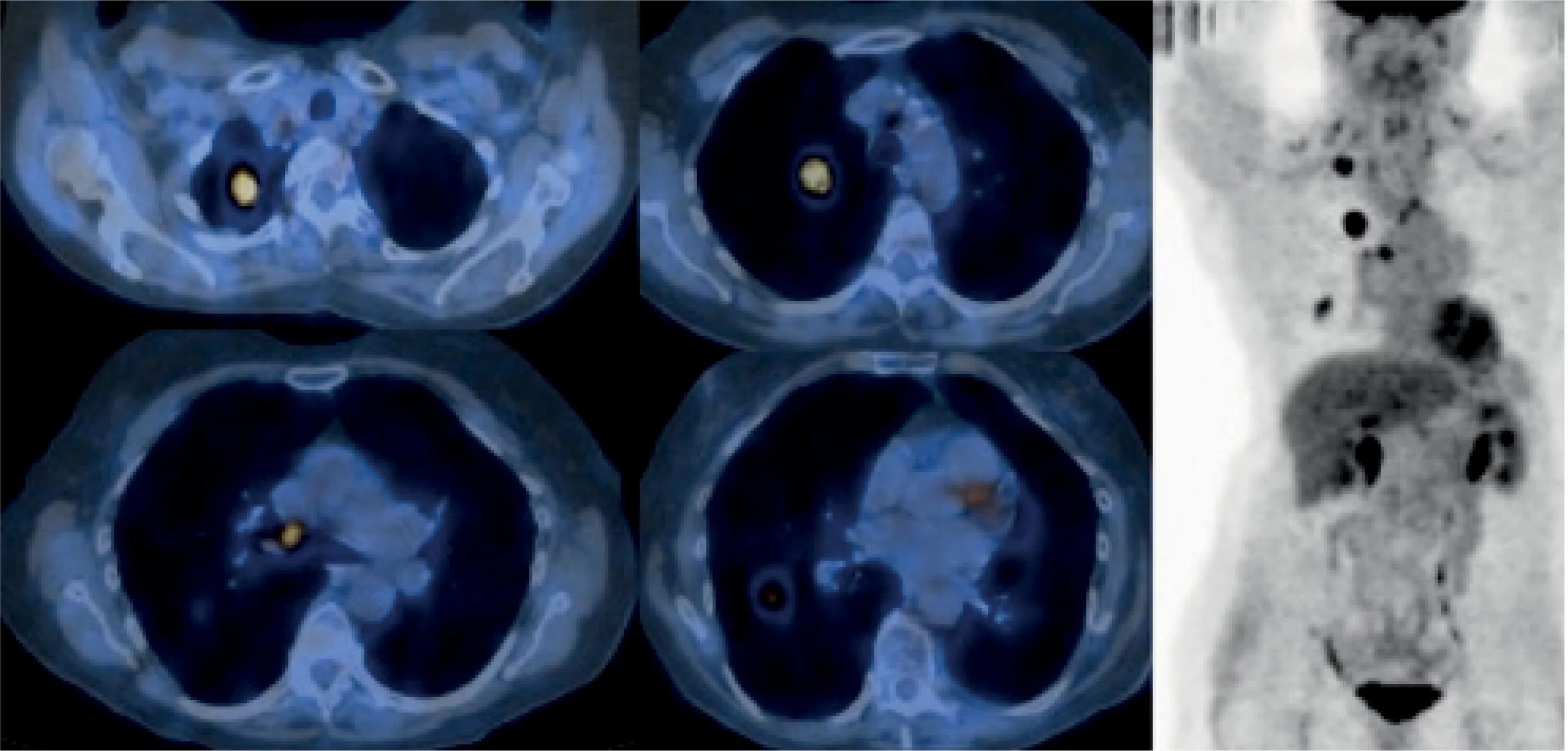 Рак 3 стадии фото SciELO - Brasil - PET/CT imaging in lung cancer: indications and findings PET/CT