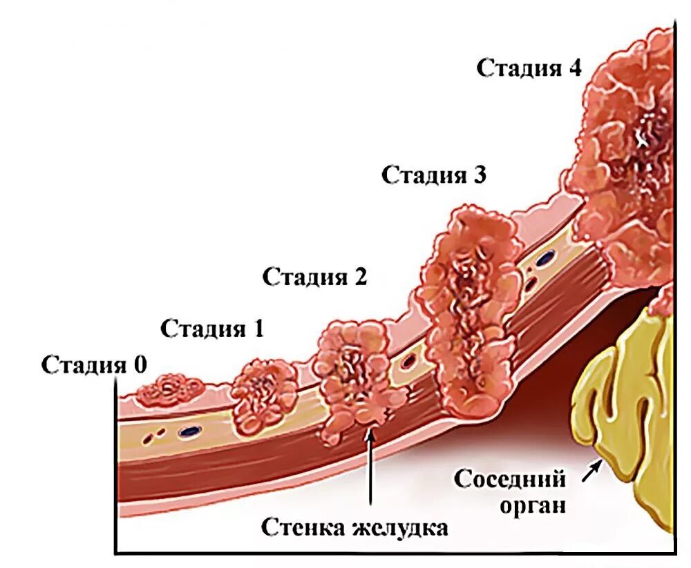 Рак 3 стадии фото Как быстро развивается рак, скорость роста опухоли, симптомы, терапия