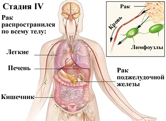 Рак 4 стадии фото Рак поджелудочной железы 4 стадии: сколько живут с диагнозом