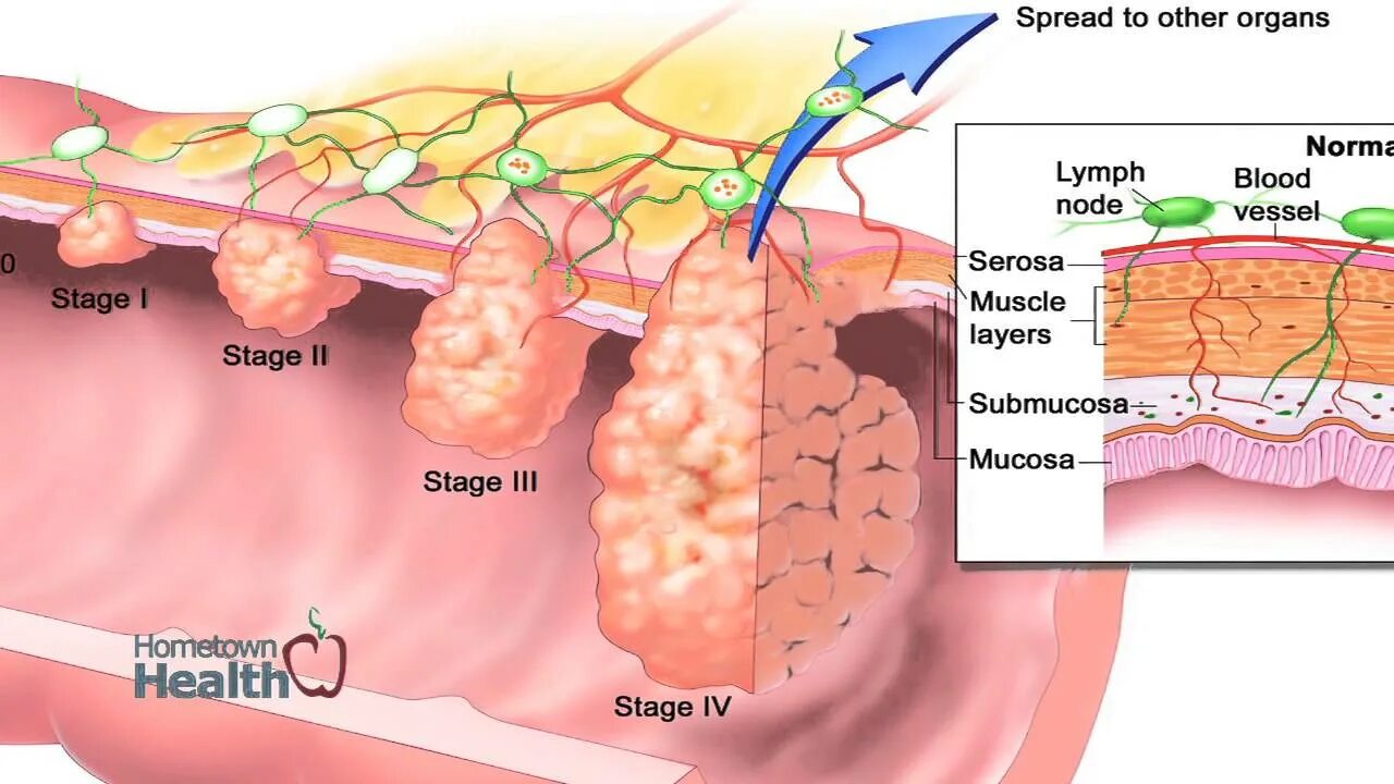 Рак 4 стадии фото Advanced Gastroenterology and Surgery Associates - Colon Cancer Screening - YouT