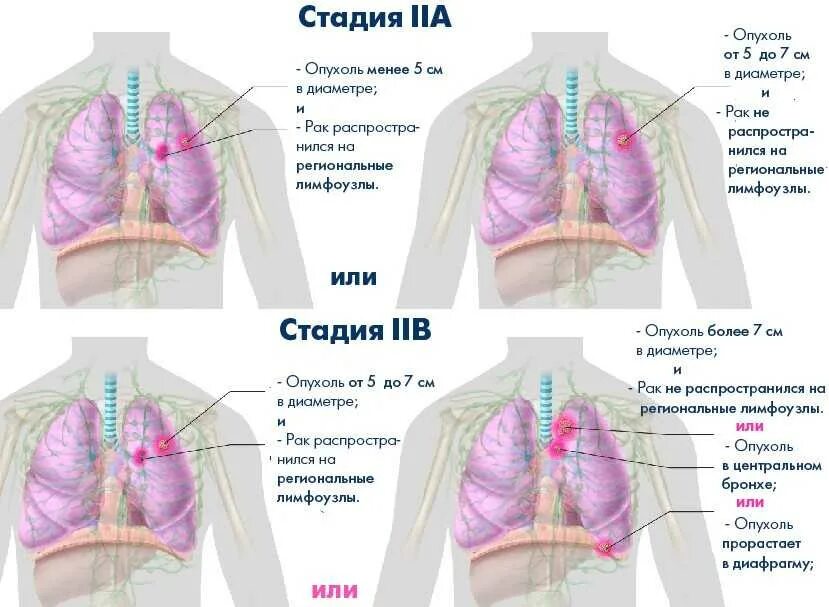 Рак 4 стадии фото Метастазы в легких какая стадия рака