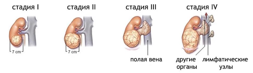 Рак 4 стадии фото Рак почки: лечение, операция по удалению опухоли почки - цена в СПб