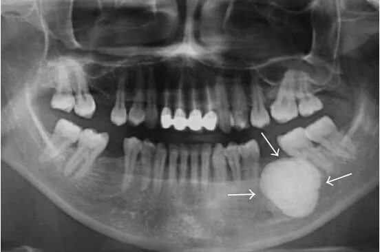 Рак челюсти симптомы фото Figure 3 from Large Peripheral Osteoma of the Mandible: A Case Report Semantic S