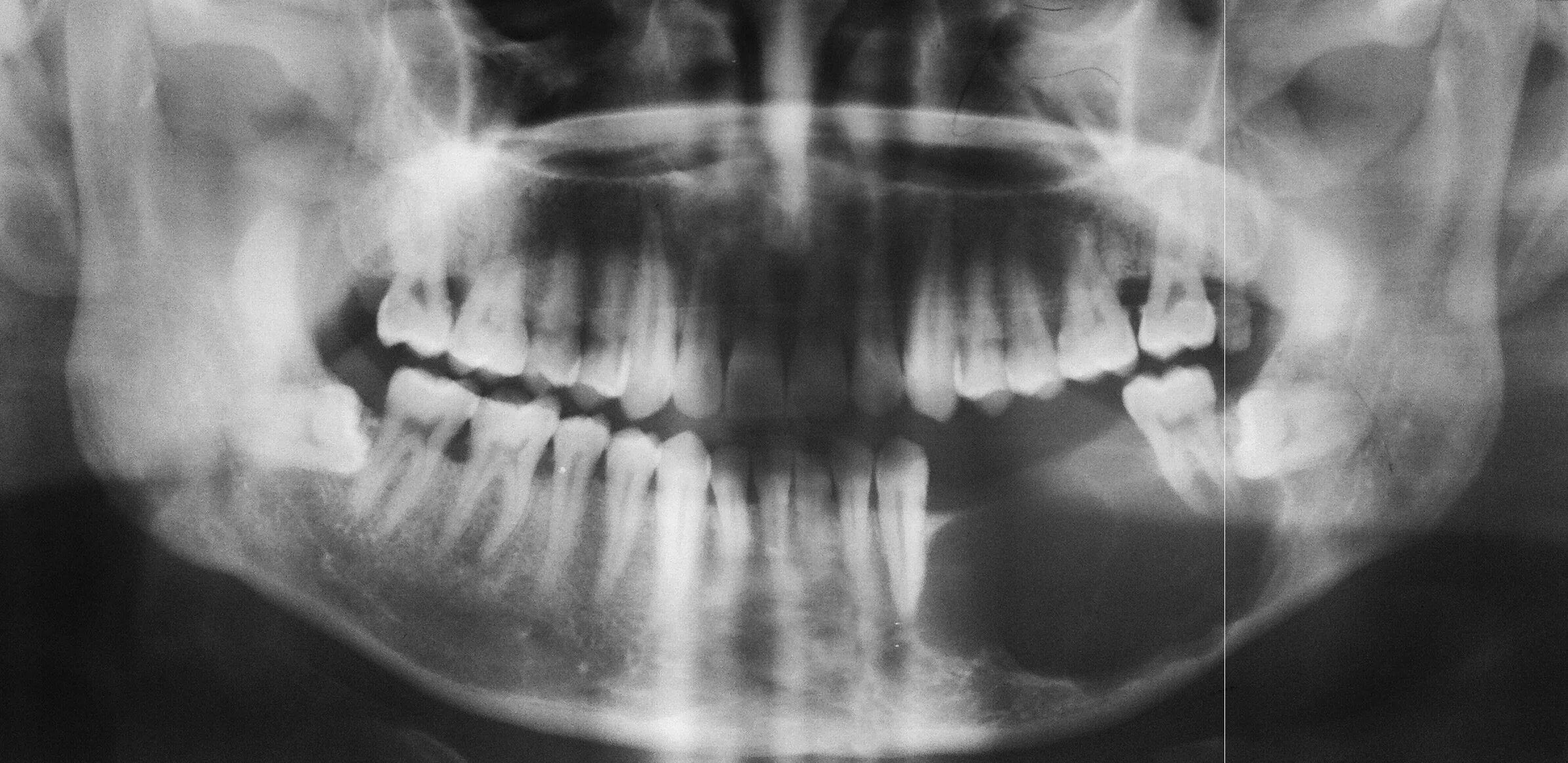 Рак челюсти симптомы фото Image Radiopaedia.org