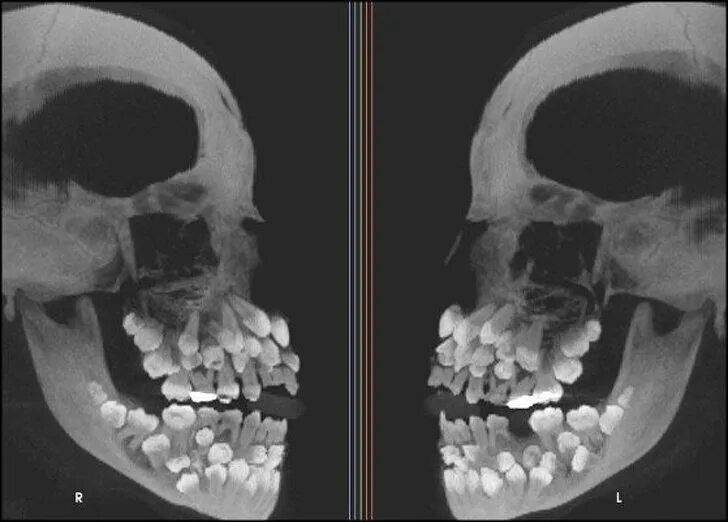 Рак челюсти у человека симптомы лечение фото Комментарии / Профиль sim31r / Хабр