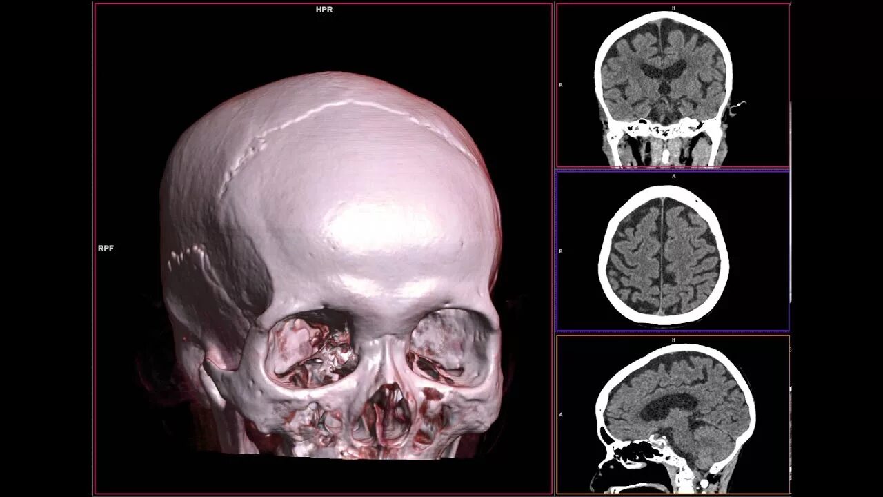 Рак черепа фото HEAD CT SCAN 3D BONE - YouTube