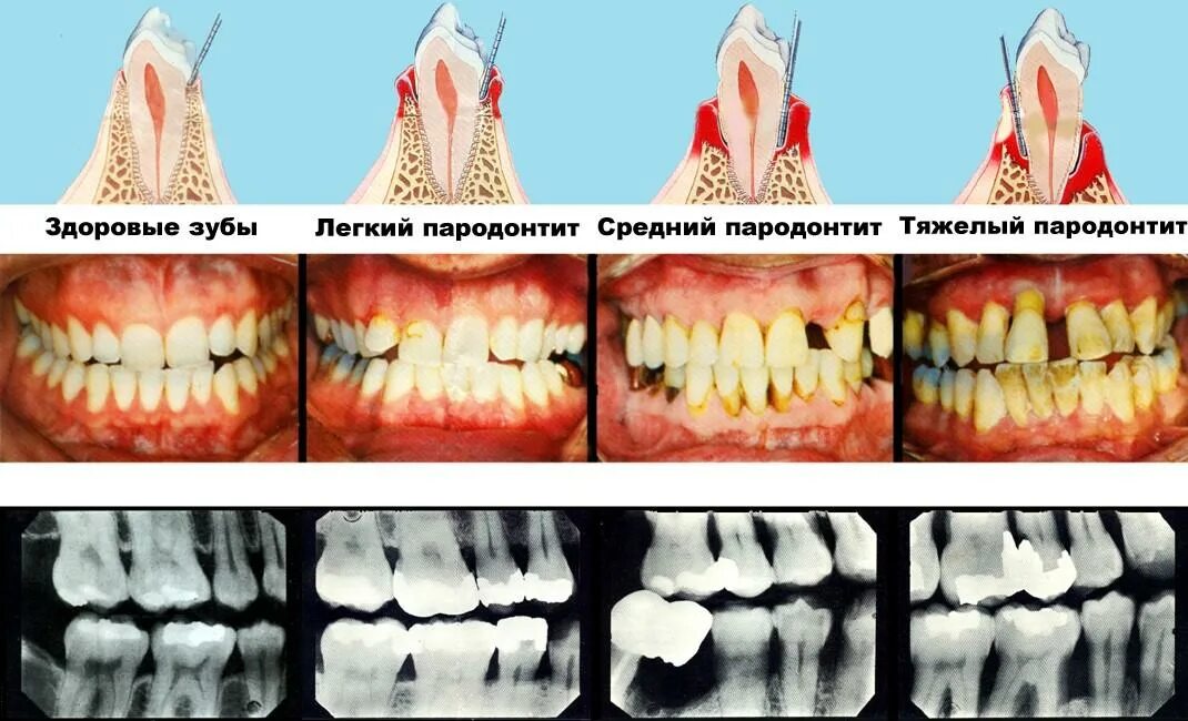 Рак десны начальная стадия симптомы фото Имплантация при пародонтозе и пародонтите - Хирургическая стоматология