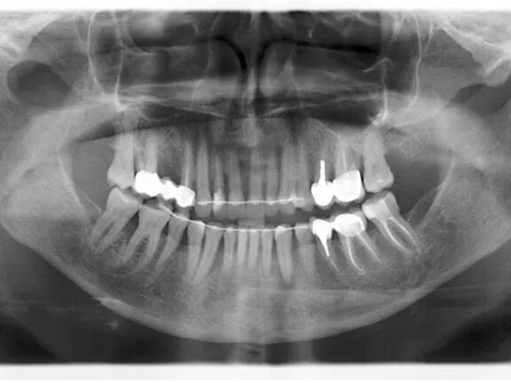 Рак десны начальная стадия симптомы фото Преимущества и недостатки панорамного снимка зубов