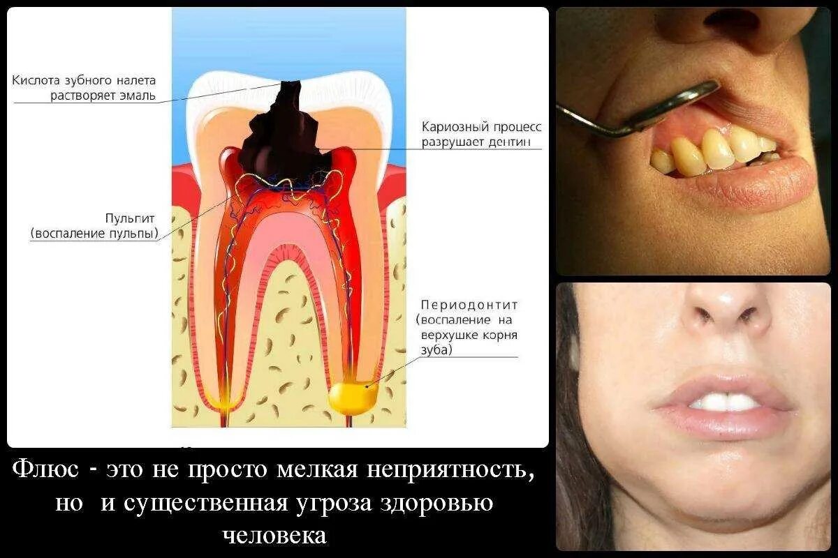 Рак десны начальная стадия симптомы фото Периодонтит зуба: цена лечения от 9 000 ₽ в Москве от стоматологии Дио Дент