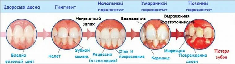 Рак десны симптомы фото признаки Пародонтология - atlantida74.ru