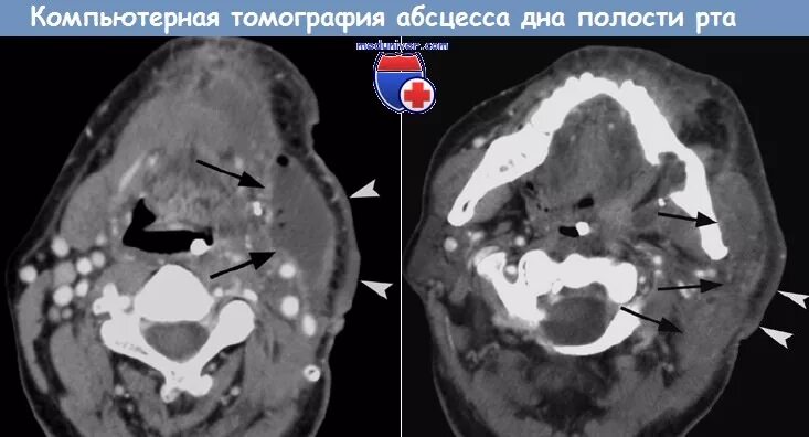 Рак дна полости рта фото начальная стадия Симптомы абсцесса дна полости рта и его лечение