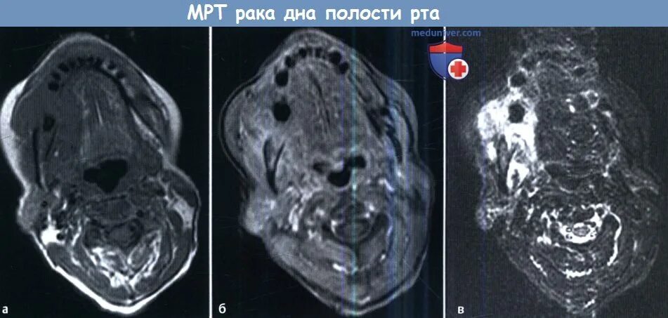 Рак дна полости рта фото начальная стадия МРТ полости рта - Виды МРТ