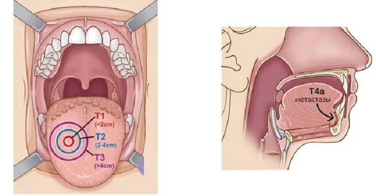 Рак дна полости рта фото начальная стадия Лечение рака полости рта в клинике OncoCareClinic 308