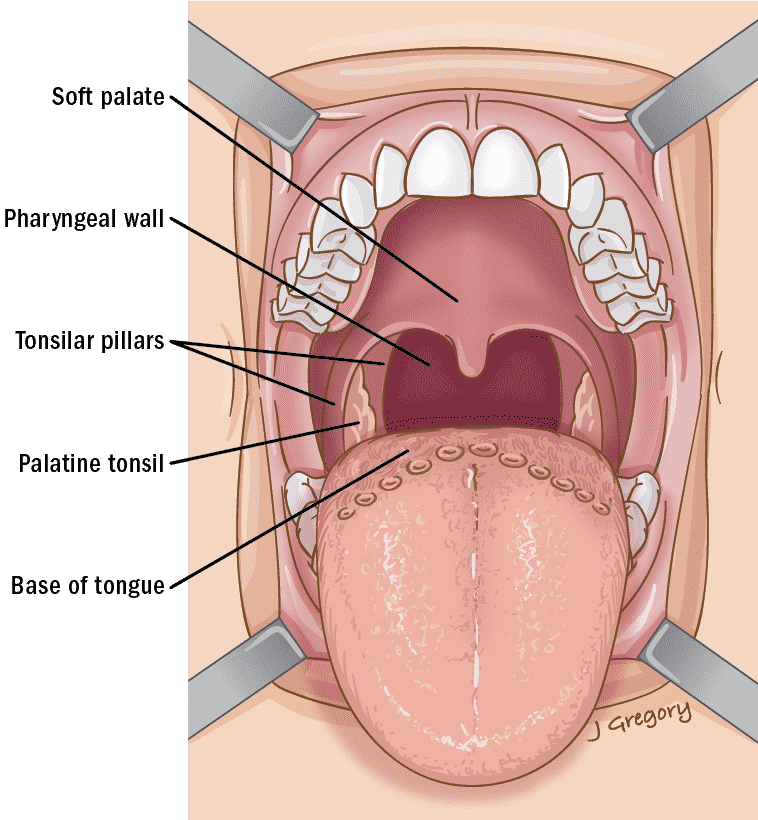 Рак гланд фото начальная стадия Oropharyngeal Cancer Anatomy * THANC Guide