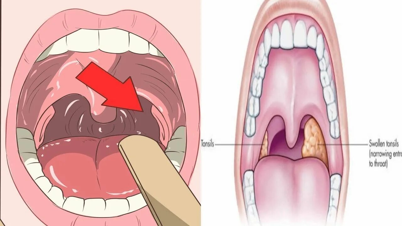 Рак гланд симптомы фото 5 Home Remedies To Remove Tonsil Stones! - YouTube