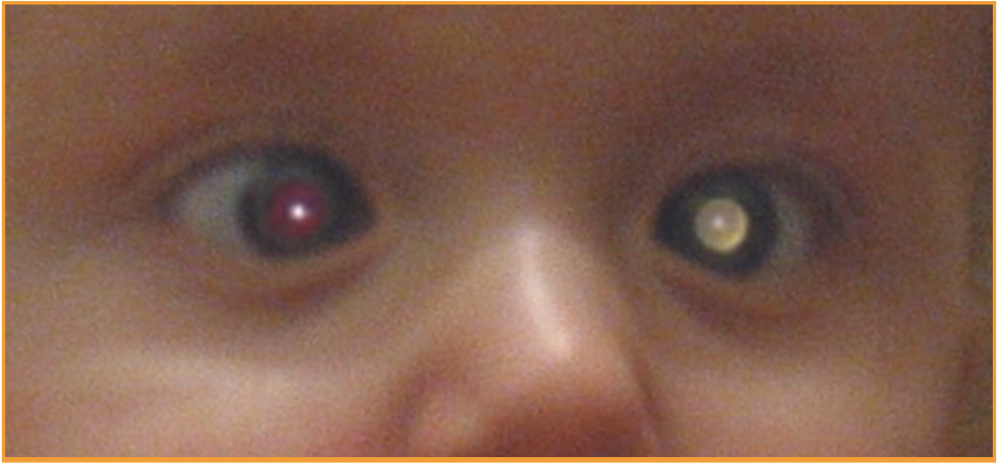 Рак глаза фото Clinical: USMLE ® Step 1 Question of the Day: Inward deviation of the eye