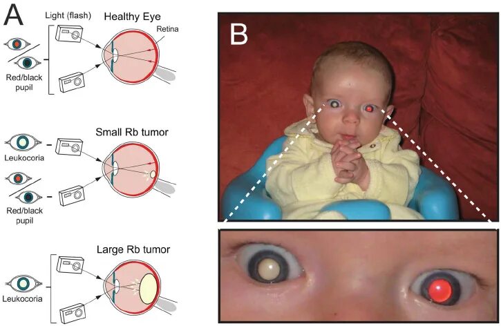 Рак глаза симптомы у взрослого фото Leukocoria in Children with Retinoblastoma. A ) The reflection of... Download Sc