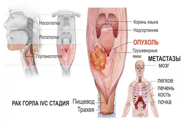 Рак горла фото 18 Рак горла симптомы и проявления: Рак гортани - симптомы и признаки. Лечение рака
