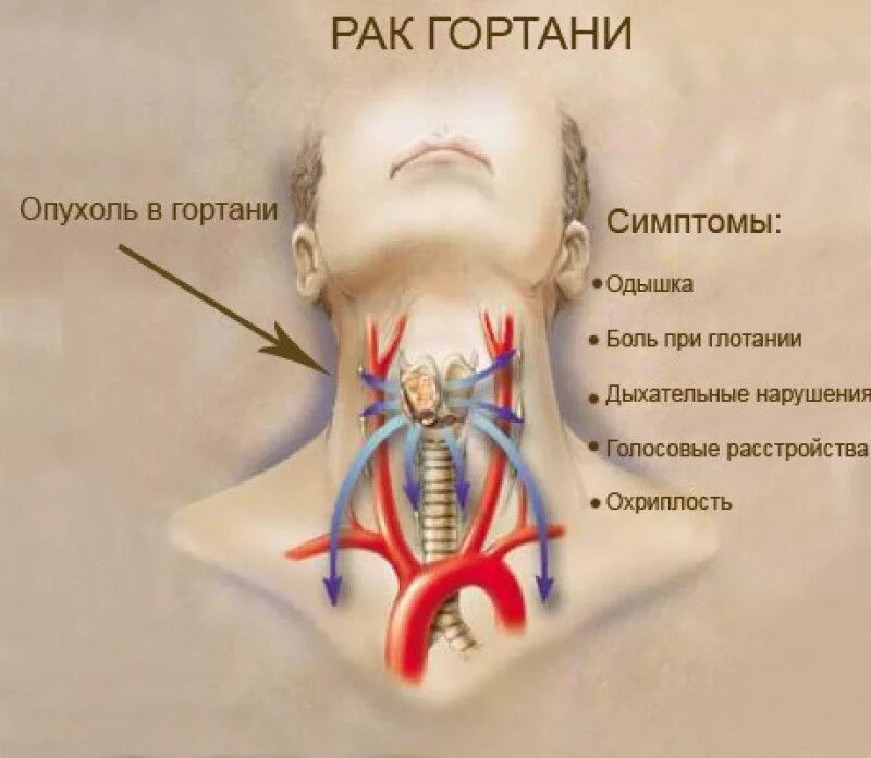 Рак горла фото Рак гортани - признаки, причины, симптомы, лечение и профилактика - iDoctor.kz