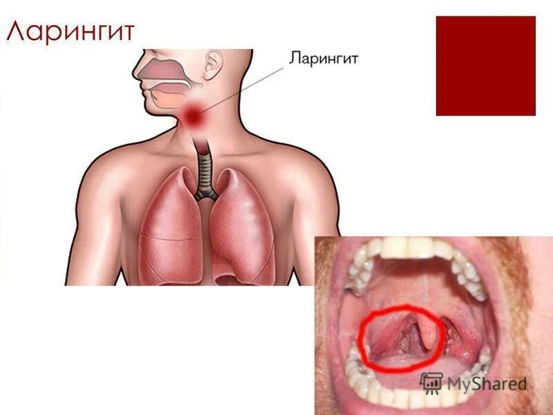 Рак горла фото у взрослого симптомы Ларингит у детей: 5 первых признаков, 6 причин, 7 симптомов, лечение в 1, 2, 3 г