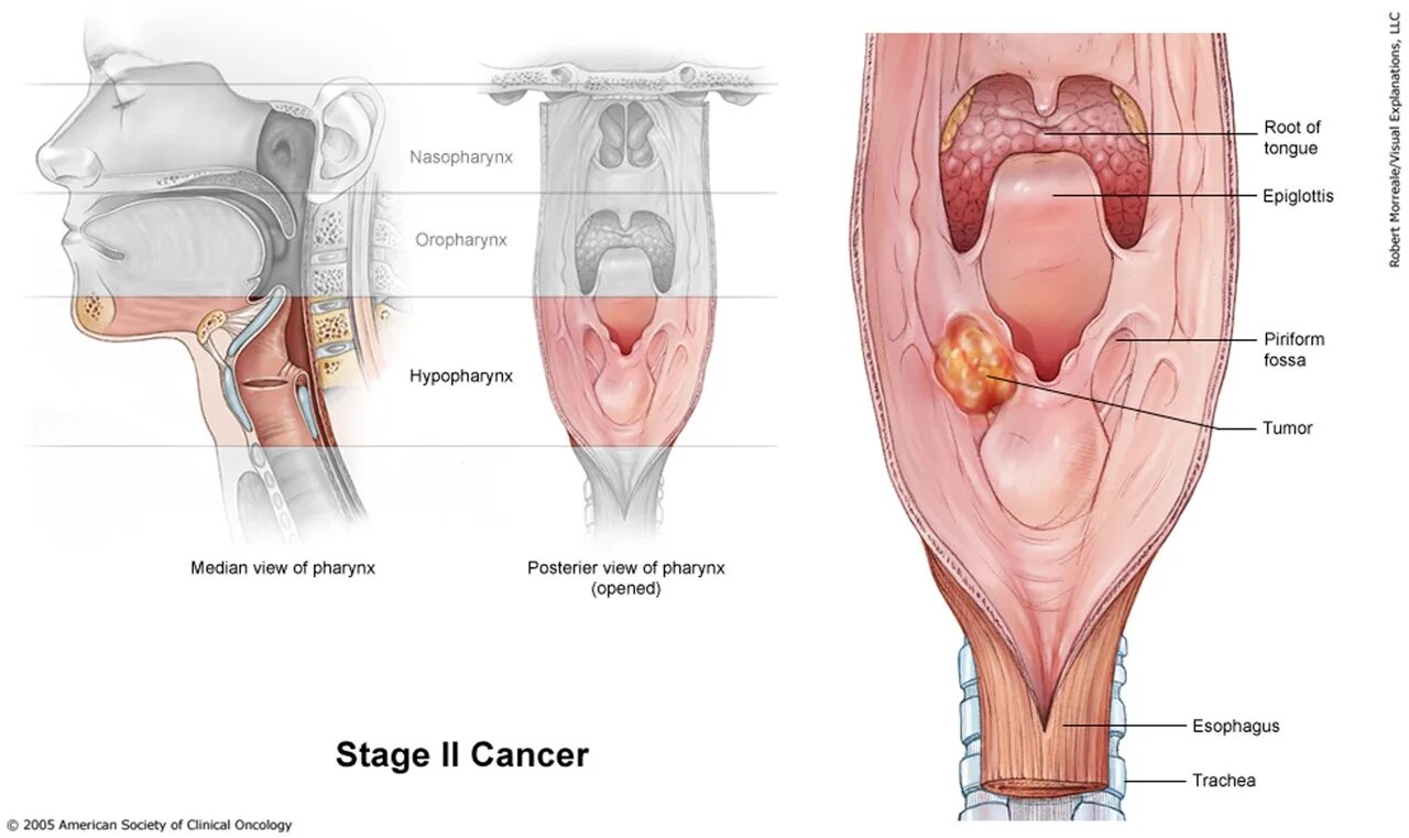 Рак горла фото внутри рта Рак ротоглотки по утвержденным клиническим рекомендациям 2020 - найдено 82 фото