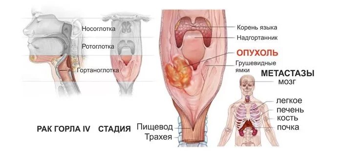 Рак горла первые признаки у женщин фото Последние публикации на сайте " Страница 165 " Информационный медицинский портал