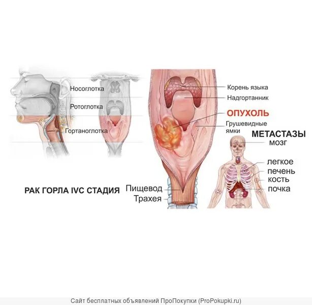 Рак горла последняя стадия фото людей Рак горла, гортани, миндалин. Лечение в Москве - бесплатное объявление из раздел