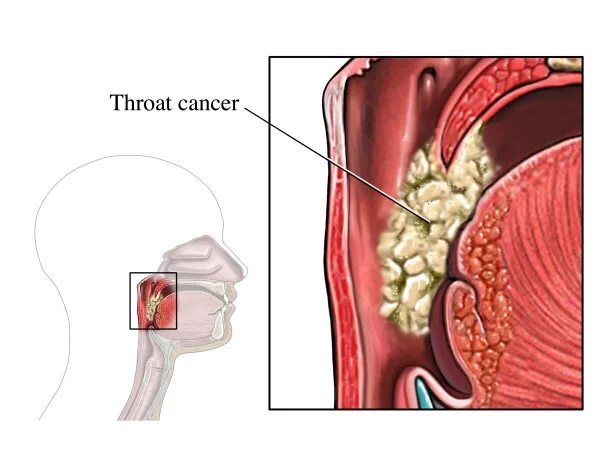 Рак горла стадии фото Первые признаки рака горла: симптомы, которые нельзя игнорировать