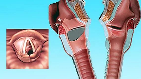 Рак гортани фото начальная стадия Рака горла и гортани на разных стадиях болезни Foto-Leto.ru