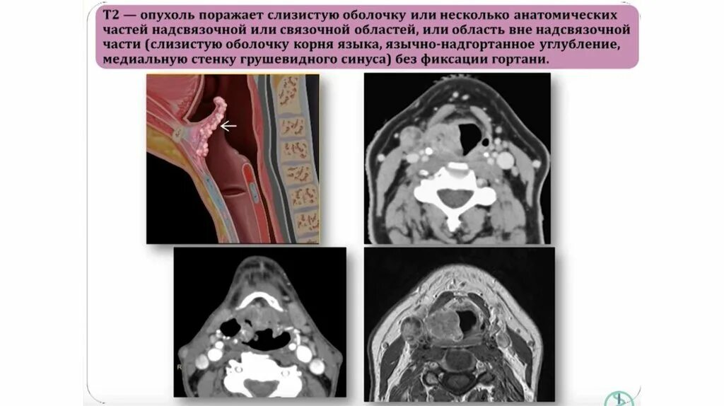 Рак гортани фото последняя стадия Рак гортани. Диагностика. Лечение. Прогноз - презентация онлайн