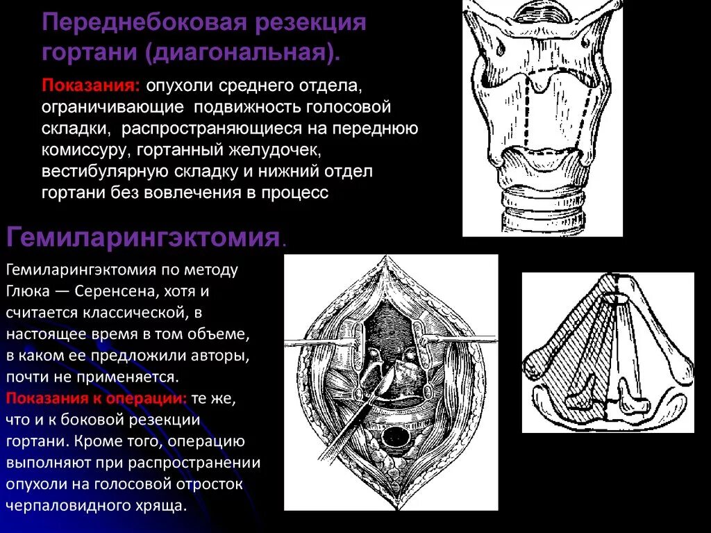 Рак гортани фото стадий Анатомия гортани - презентация онлайн