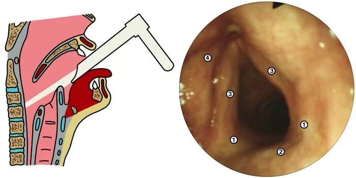 Рак гортани фото стадий Ларингоскопия это... Что такое Ларингоскопия?