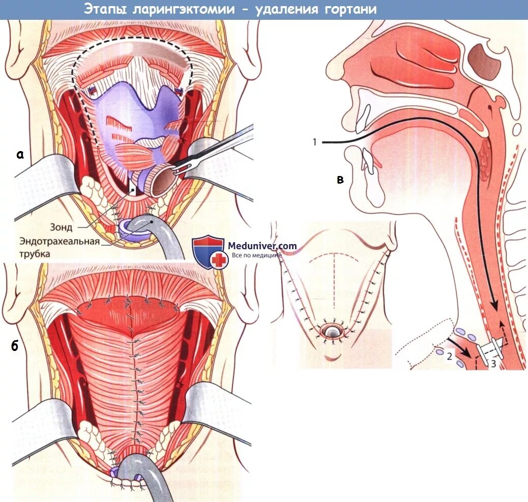 Рак гортани фото стадий Техника операции при раке гортани