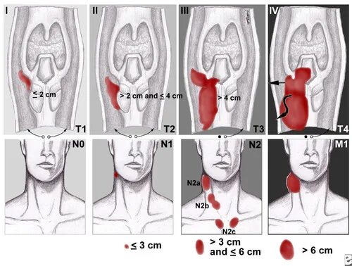 Рак гортани фото стадий Head and Neck Cancer Staging and Guidelines Flashcards Quizlet