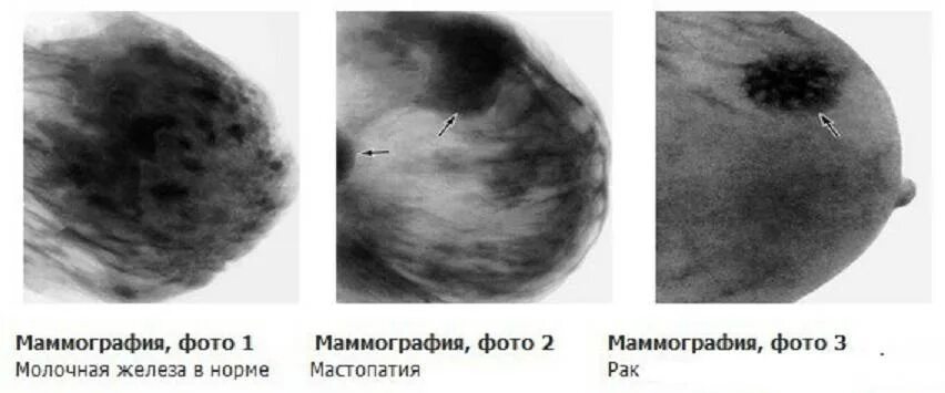 Рак груди 4 стадия фото Рентгенологическая картина фиброзно кистозной мастопатии