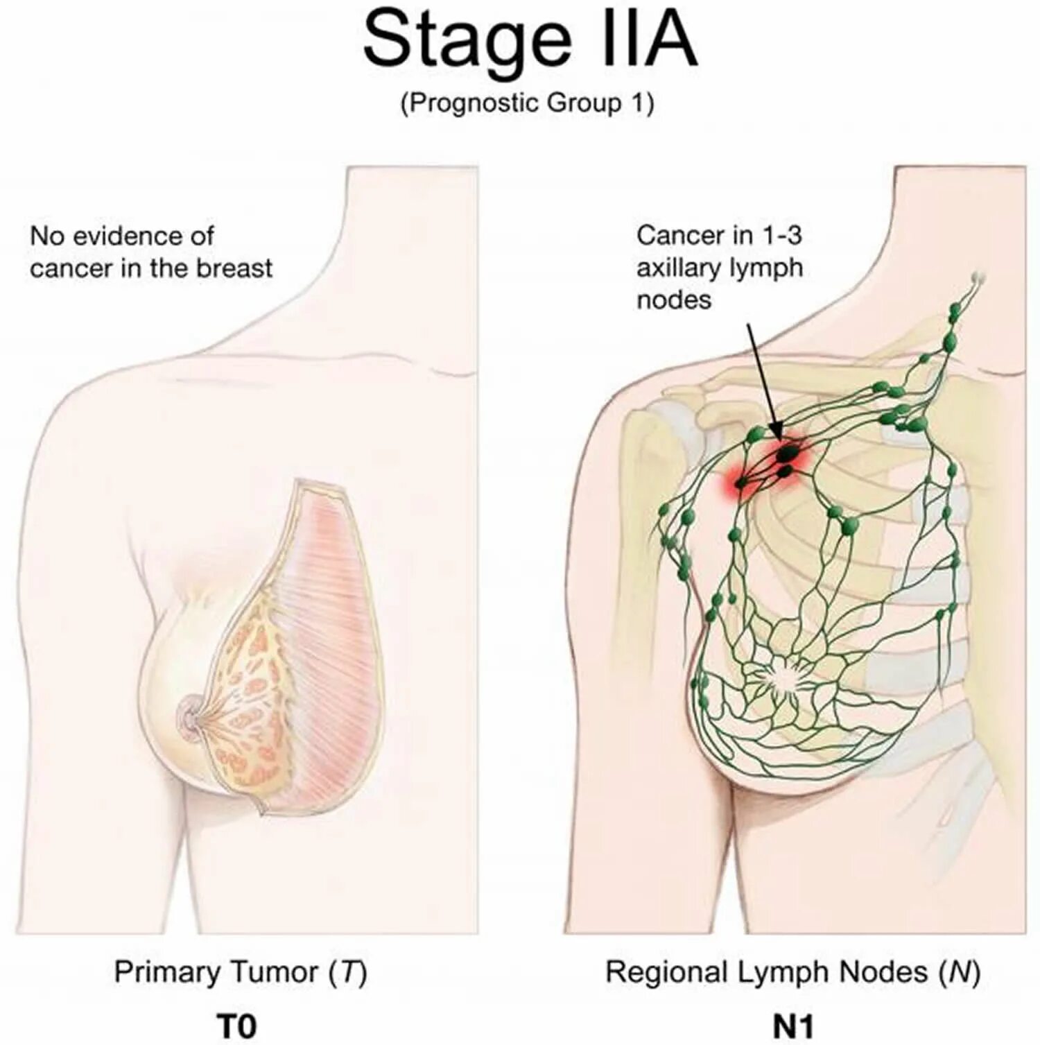 Рак груди 4 стадия фото Breast Cancer - Causes, Signs, Symptoms, Types, Treatment