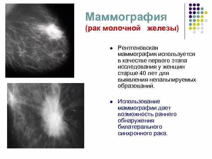 Рак груди 4 стадия фото распад Рмж 1 стадия гормонозависимый