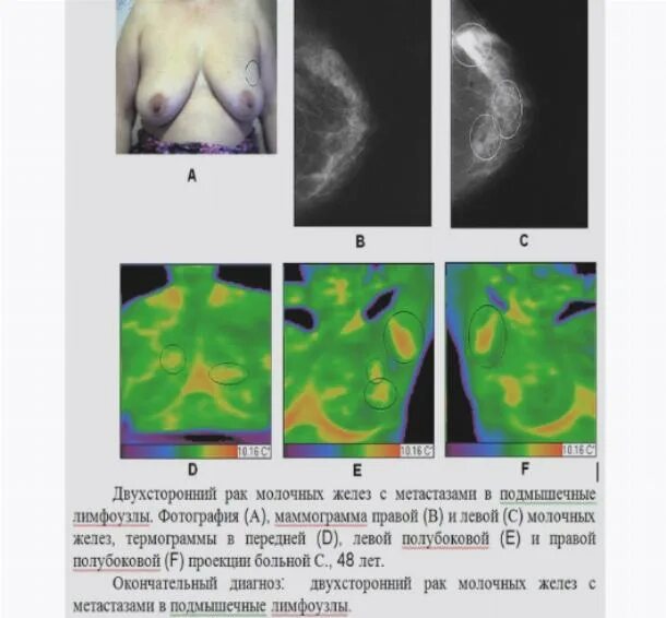 Термографическая диагностика заболеваний молочных желез.Продолжение. Здравия жел