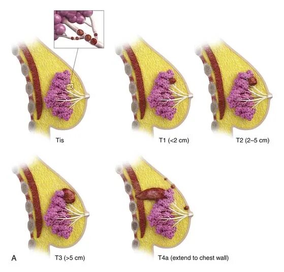 Рак груди фото начальная стадия как выглядит Breast Cancer Clinical Gate
