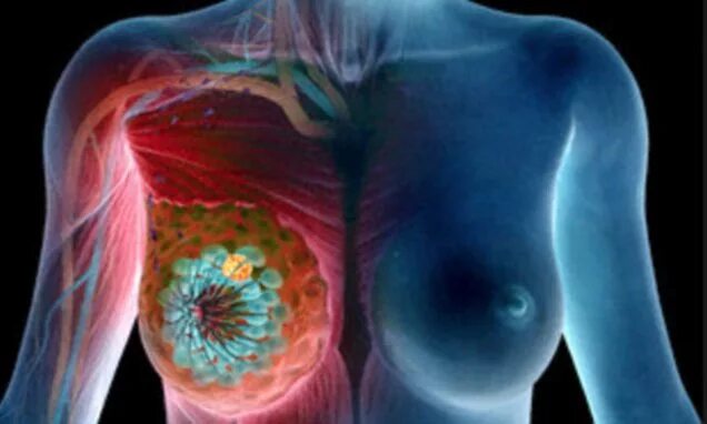 Рак груди фото снаружи New test 'accurately' spots the most deadly forms of breast cancer BEFORE they s