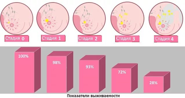 Рак груди начальная стадия фото Лечение рака груди в Германии: маммология, онкология молочной железы, цены, отзы