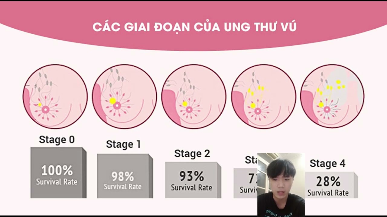 Рак груди начальная стадия фото Tài chính tiêu dùng - YouTube