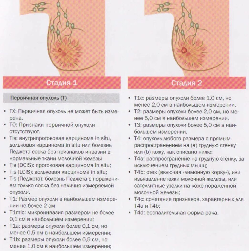 Рак груди первой стадии фото Первые стадии рака молочной железы: начало опухолевого роста