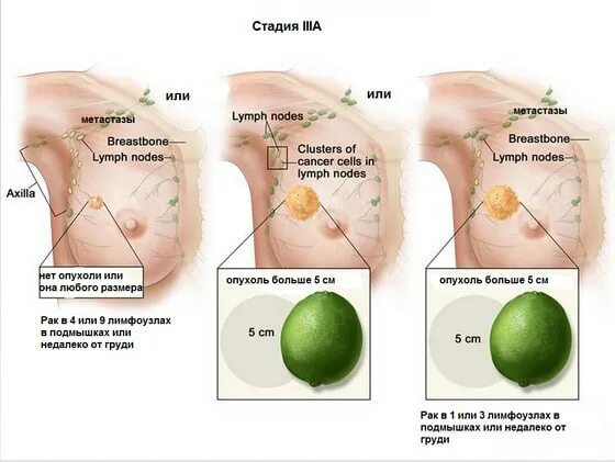 Рак груди симптомы признаки фото Лечение рака молочной железы 3 стадии в Израиле в клинике Ассута