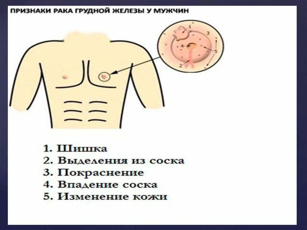 Рак груди у мужчин симптомы признаки фото Гинекомастия и рак грудной железы - презентация онлайн